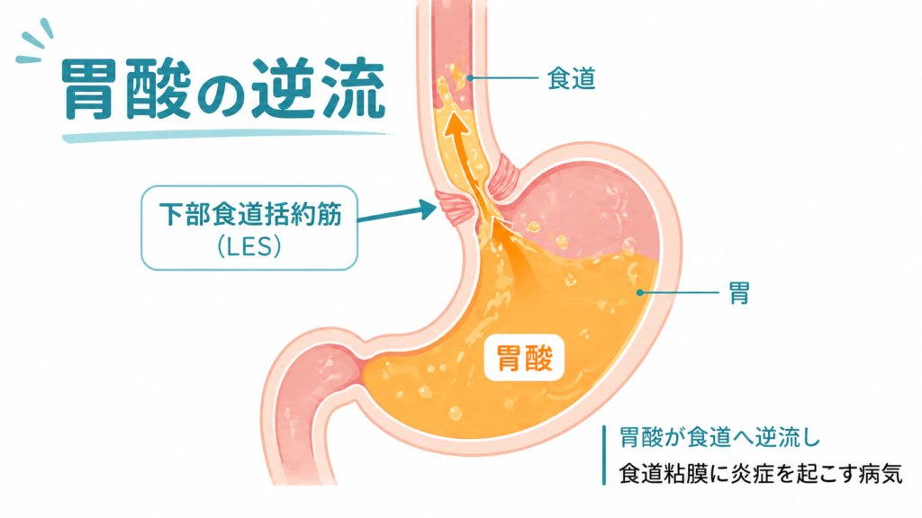 胃酸が食道へ逆流する仕組みの解剖図