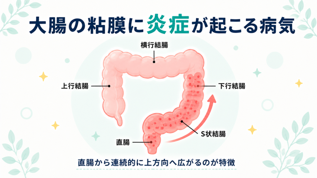 大腸の全体図と、直腸から連続的に炎症が広がる様子を示す図解