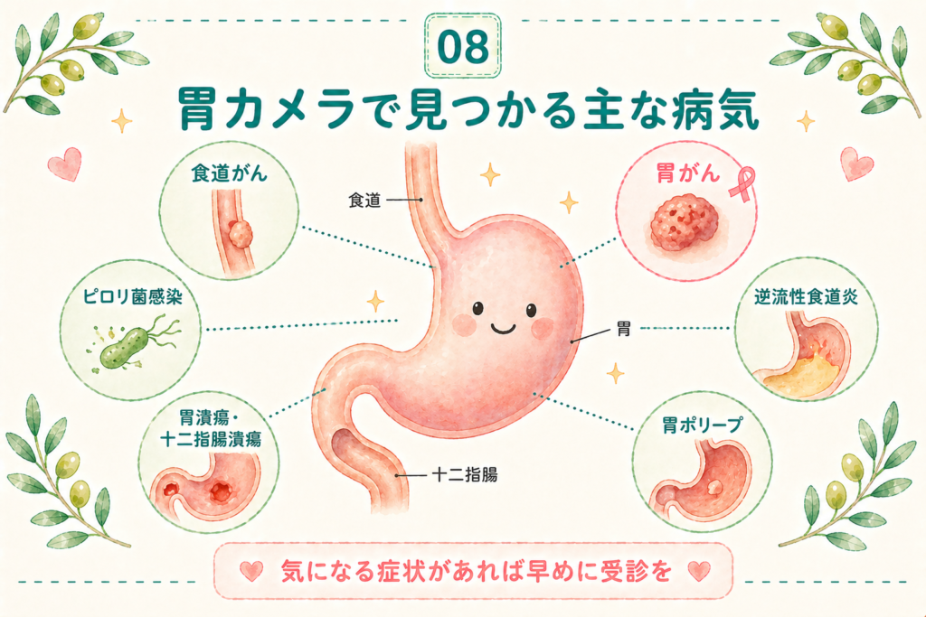 胃カメラで発見できる胃がん・食道がん・ピロリ菌感染胃炎などの主な病気のイラスト