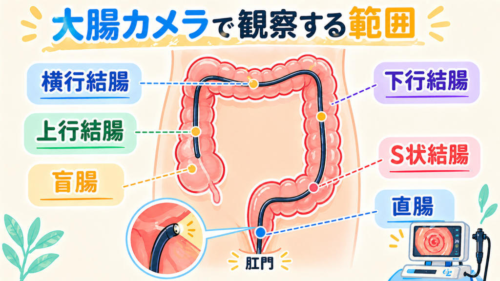 肛門から内視鏡を挿入して大腸全体を観察する大腸カメラ検査のイラスト