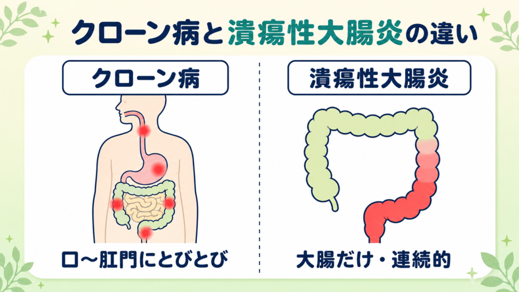 クローン病と潰瘍性大腸炎の違いを比較した図。クローン病は口から肛門までとびとび、潰瘍性大腸炎は大腸だけ連続的に炎症が起こることを表す。
